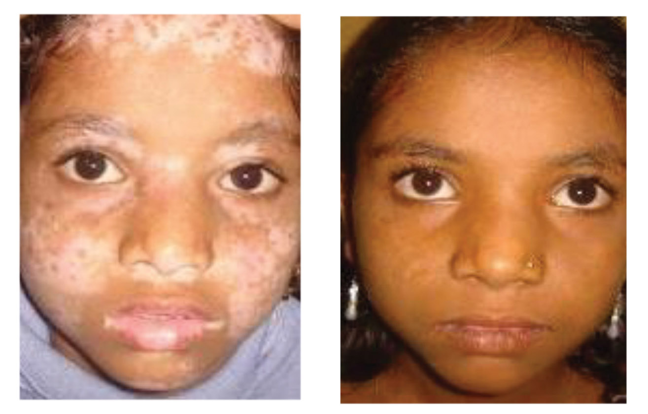 Vitiligo before and after 22 weeks of treatment. Photos courtesy Dr. Sakhiya